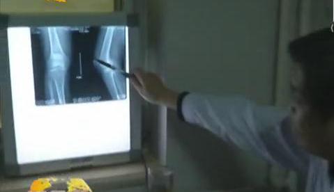 冷空氣來(lái)襲 如何預(yù)防老寒腿？